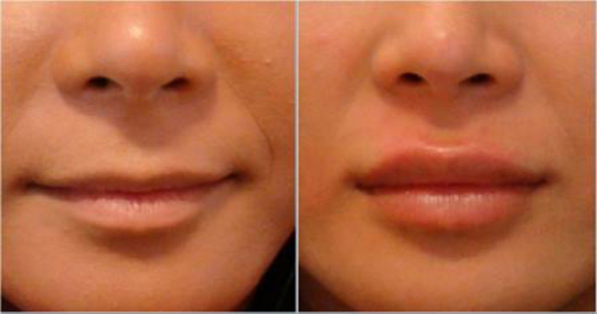 Удаление малых губ до и после фото. Увеличение верхней губы.